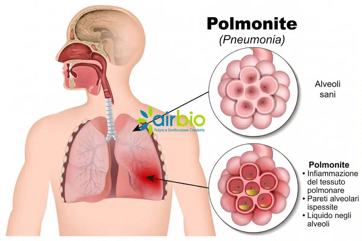 Sintomi polmonite da legionella Sintomi polmonite da legionella